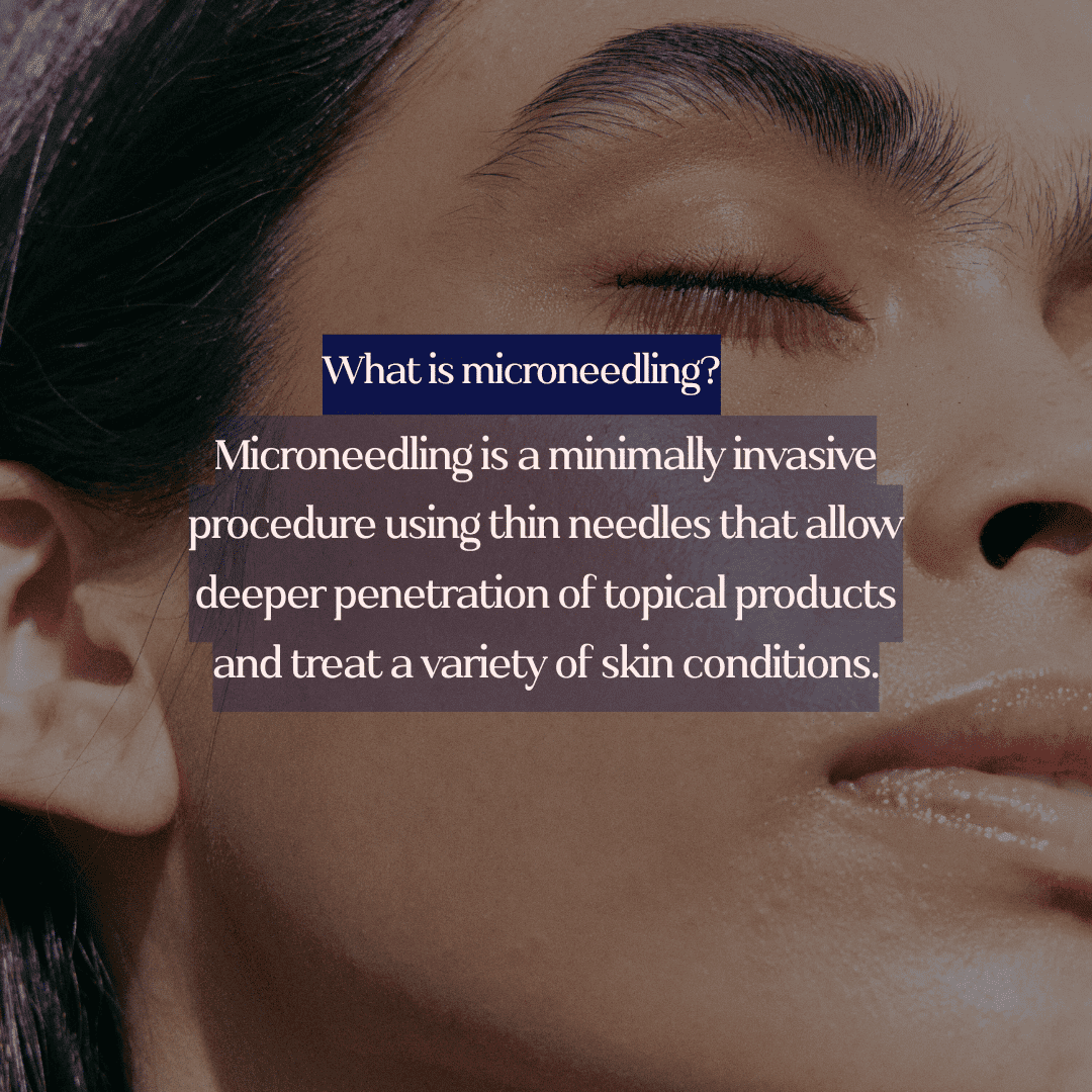 Close-up of a woman's face with text explaining microneedling benefits.