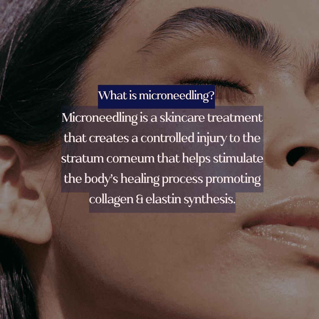 Microneedling description overlayed on a close-up of a woman's face with her eyes closed.